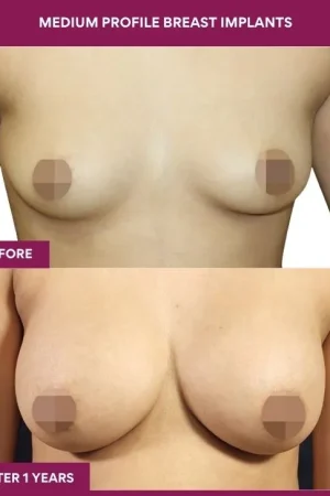 2 Medium Profile Breast Implants_6