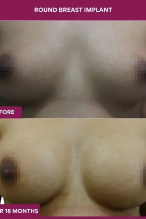 2 Round breast implant_6_ (1)