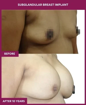 2 SUBGLANDULAR BREAST IMPLANT (3)_5