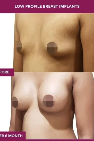 2 low Profile Breast Implants (3)_5