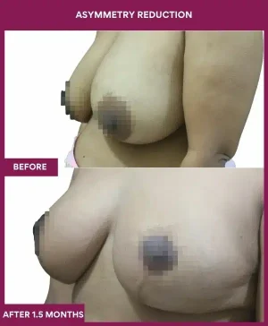 3 Asymmetry Reduction (2)