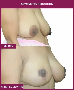 3 Asymmetry Reduction (3)