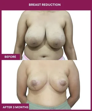 3- Breast Reduction_9_ (1)