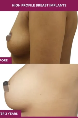 3 High Profile Breast Implants (2)_8_