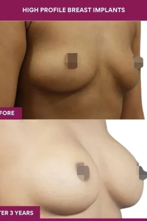 3 High Profile Breast Implants (3)_8_