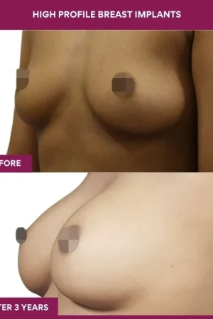 3 High Profile Breast Implants (4)_8_