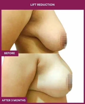 3 Lift reduction (2)