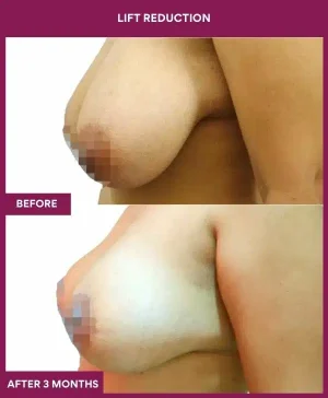 3 Lift reduction (3)