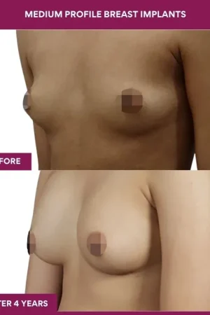 3 Medium Profile Breast Implants (2)_7