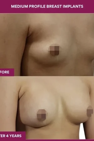 3 Medium Profile Breast Implants (3)_8