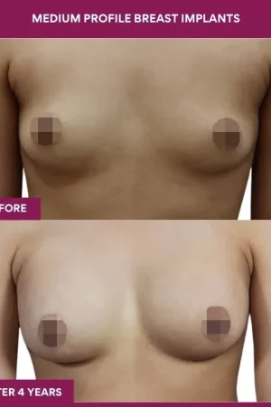 3 Medium Profile Breast Implants_9