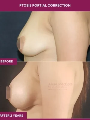 3 Ptosis Portial Correction (5)_8_