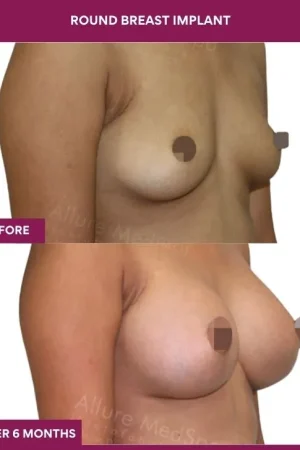 3 Round breast implant (3)_8_
