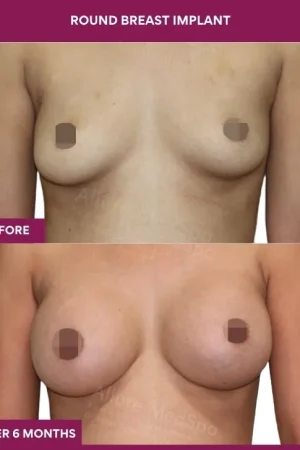 3 Round breast implant (4)_8_