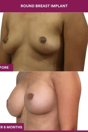 3 Round breast implant (5)_8_