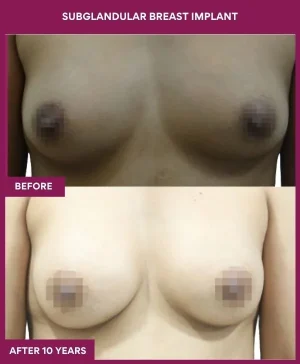 3 SUBGLANDULAR BREAST IMPLANT_9_ (1)