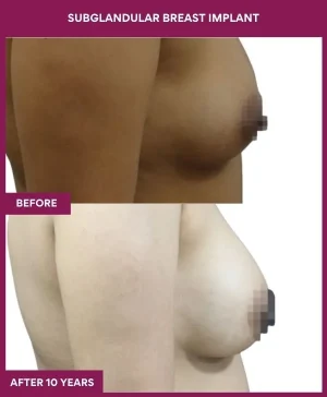 3 SUBGLANDULAR BREAST IMPLANT_9_ (2)