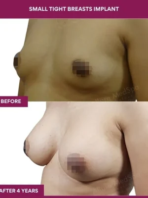 3 Small Tight Breasts Implant_9 (2)