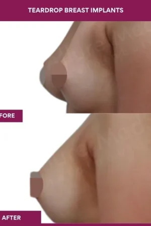 3 Teardrop Breast Implants_9 (2)