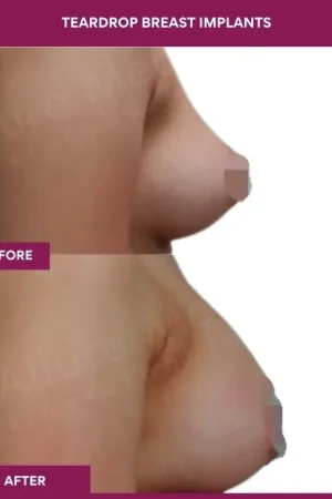 3 Teardrop Breast Implants_9 (3)