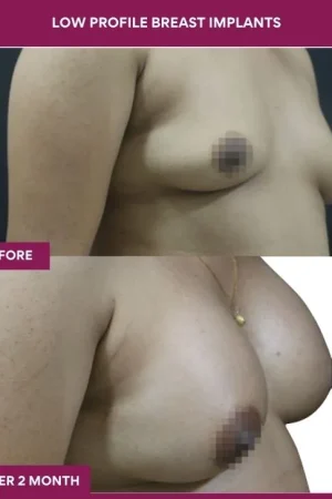 3 low Profile Breast Implants (2)_7