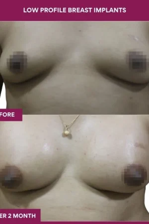 3 low Profile Breast Implants_9