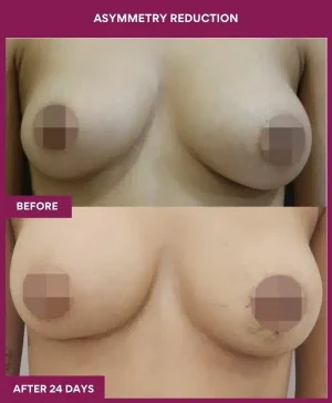 4 Asymmetry Reduction
