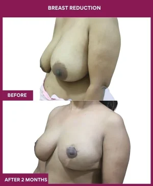 4-Breast Reduction_12_ (3)