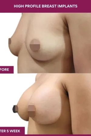 4 High Profile Breast Implants (3)_11