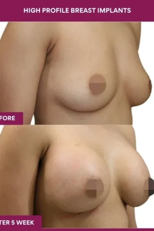4 High Profile Breast Implants (4)_11