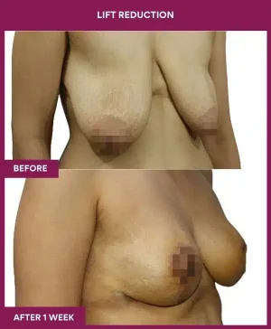 4 Lift reduction (2)