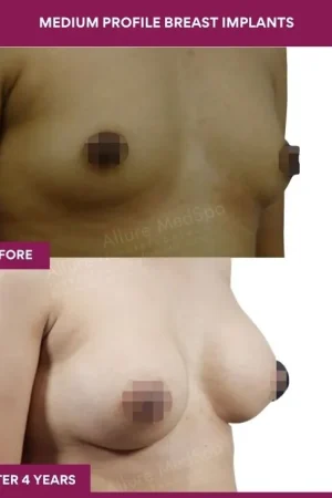 4 Medium Profile Breast Implants (2)_10