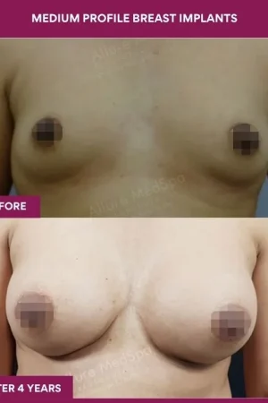 4 Medium Profile Breast Implants_12