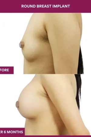 4 Round breast implant (3)_11