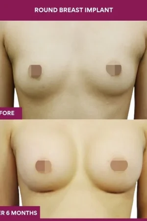 4 Round breast implant (4)_11