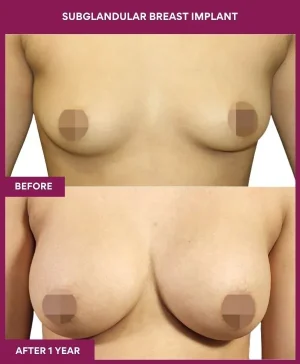 4 SUBGLANDULAR BREAST IMPLANT_11 (1)