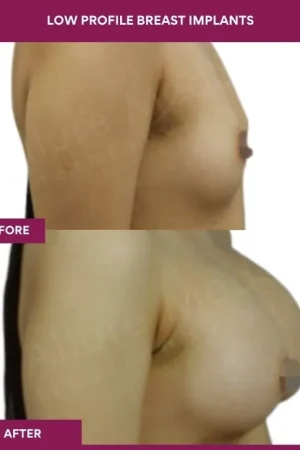 4 low Profile Breast Implants (2)_10