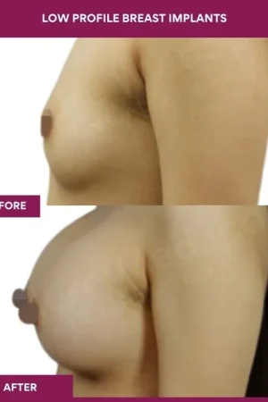 4 low Profile Breast Implants (3)_11