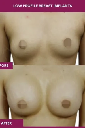 4 low Profile Breast Implants_12