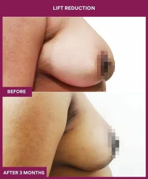 5 Lift reduction (2)