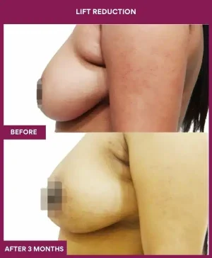 5 Lift reduction (3)