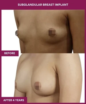 5 SUBGLANDULAR BREAST IMPLANT_15_ (2)