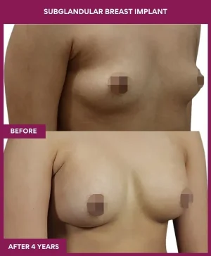 5 SUBGLANDULAR BREAST IMPLANT_15_ (3)