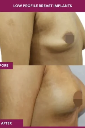 5 low Profile Breast Implants (2)_13