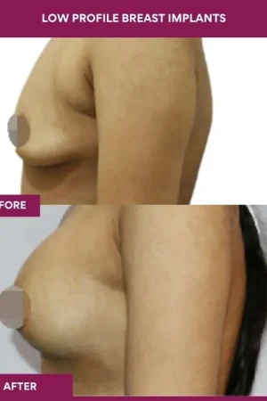 5 low Profile Breast Implants (3)_14