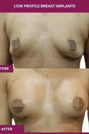 5 low Profile Breast Implants_15
