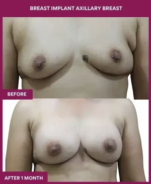BREAST IMPLANT AXILLARY BREAST in Mumbai, India