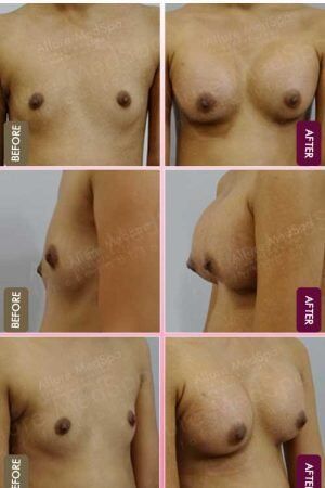 Saline-Breast-Implant-Before-After-gallery-mumbai-india