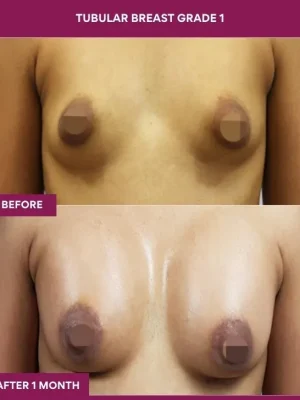 TUBULAR BREAST GRADE 1 (4)_1