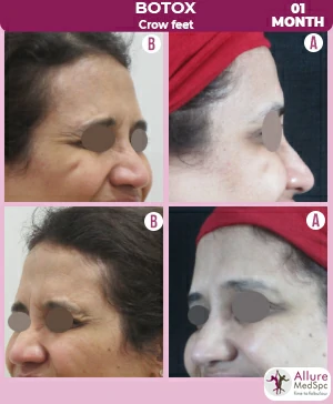 Botox_Crowfeet